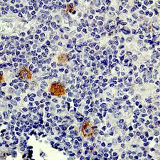 IHC - Cluster of Differentiation 30 (CD30)